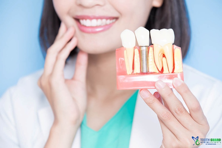 stem cell dental implants